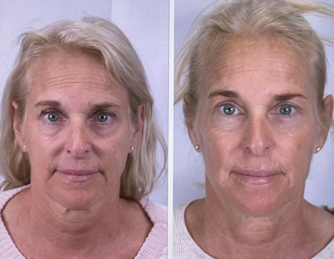 skin rejuvenation before and after 2